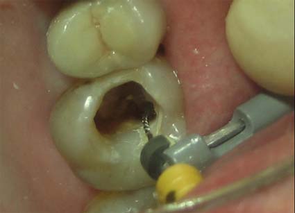 Гель для расширения и выявления устья каналов зубов - ЭДТА 20% - 5 мл. / ТехноДент