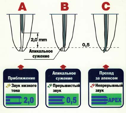 Лечение корневых каналов